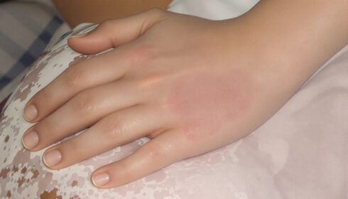Atopická dermatitida je onemocnění, které zásadně ovlivňuje kvalitu života